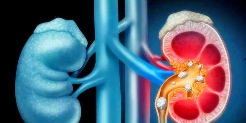 肾结石吃角瓜,角瓜助力健康排石新选择